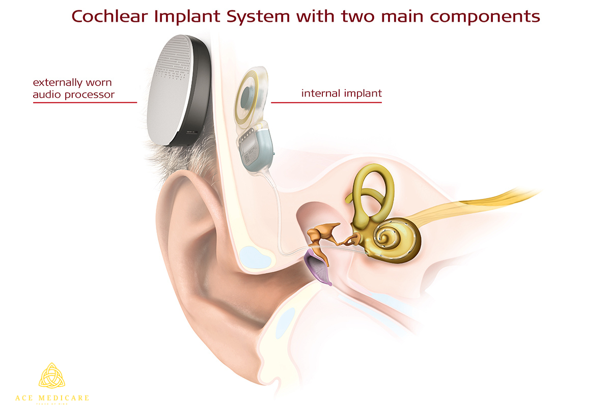 Debunking 5 Common Misconceptions About Middle Ear Transplant Surgery